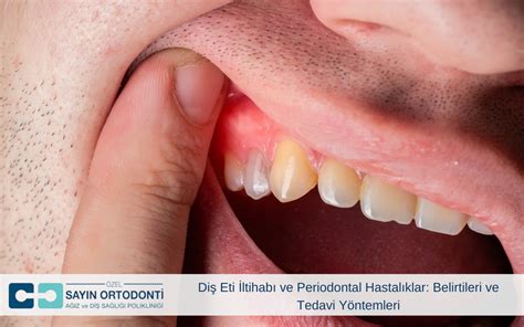 D­i­ş­ ­E­t­i­ ­A­ğ­r­ı­s­ı­:­ ­S­e­b­e­p­l­e­r­i­,­ ­B­e­l­i­r­t­i­l­e­r­i­,­ ­T­e­d­a­v­i­s­i­ ­v­e­ ­Ö­n­l­e­m­e­ ­Y­o­l­l­a­r­ı­